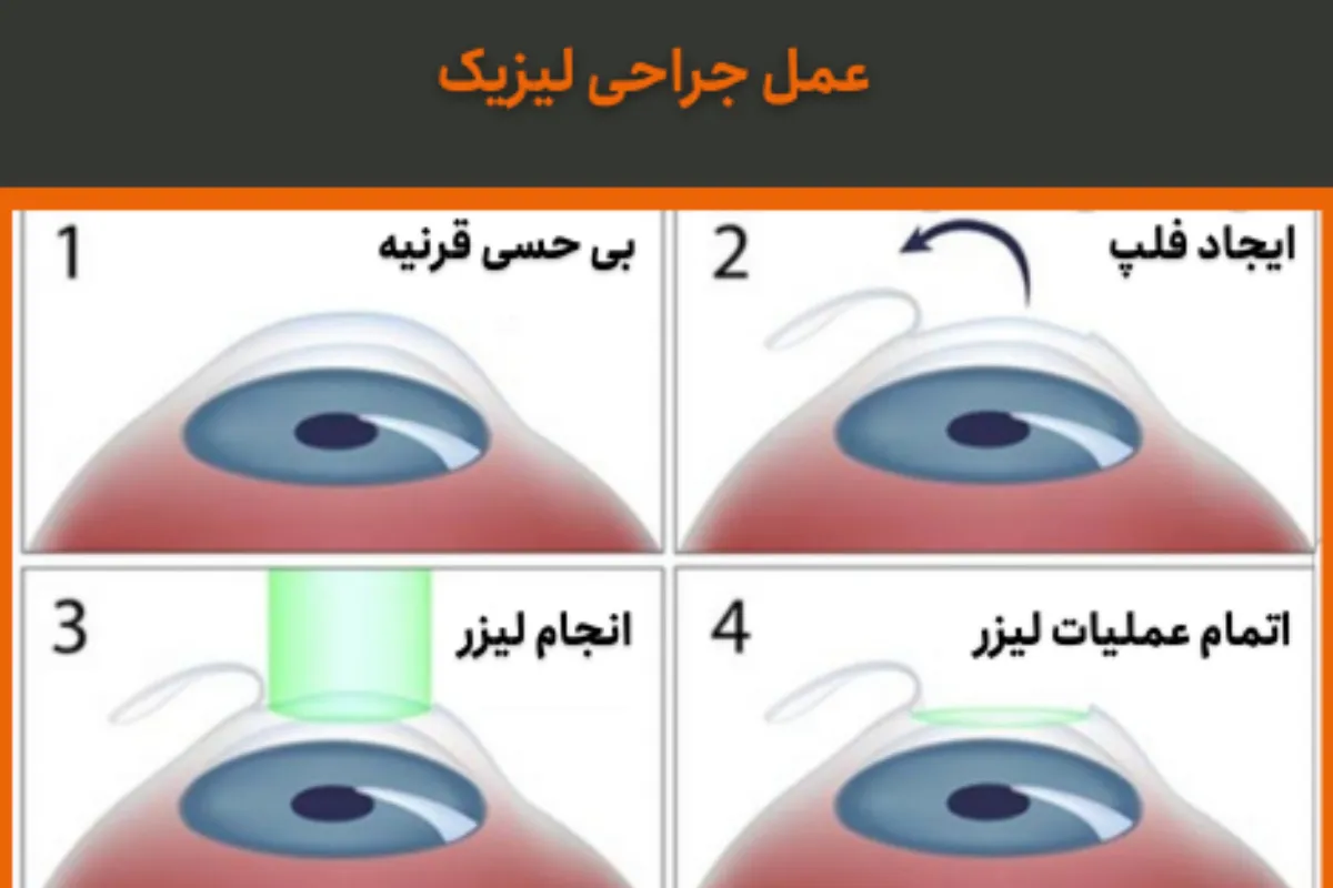 مراحل عمل لیزیک چشم همراه با نکات مراقبت‌ بعد از عمل لیزیک چشم