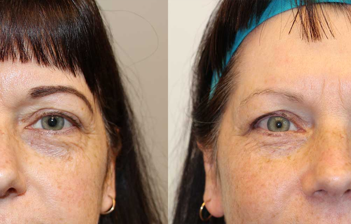 اجتناب از لنز چشم و آرایش