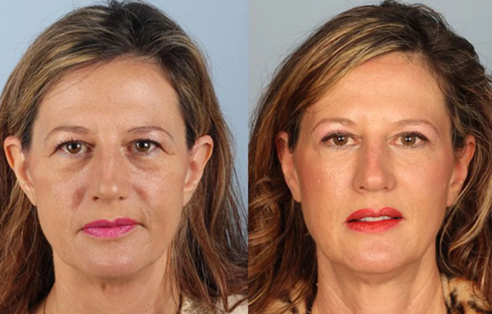 جراحی پلک چیست