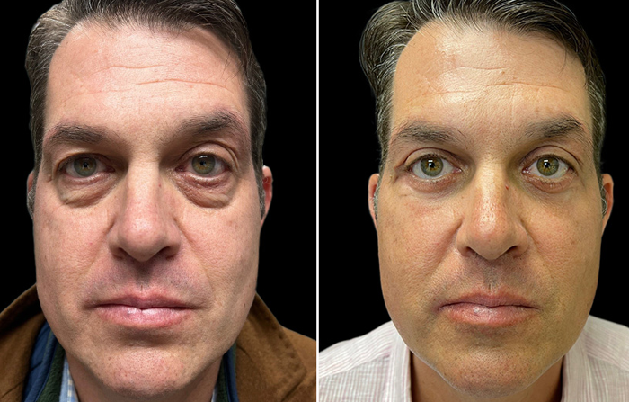 بهترین سن برای عمل بلفاروپلاستی