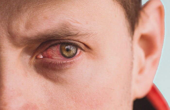 روش‌های تشخیص خشکی چشم