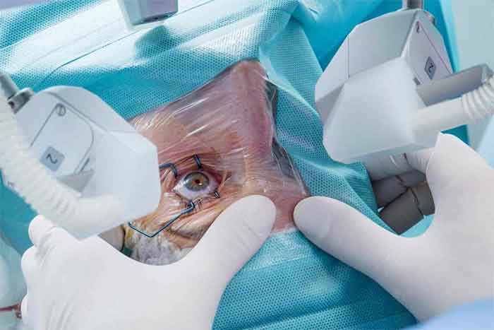 عمل آب مروارید چیست؟