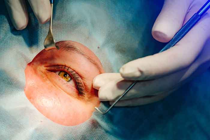 عمل آب مروارید چه زمانی ضرورت پیدا می‌کند؟