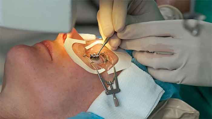 عمل لیزیک چشم چیست؟