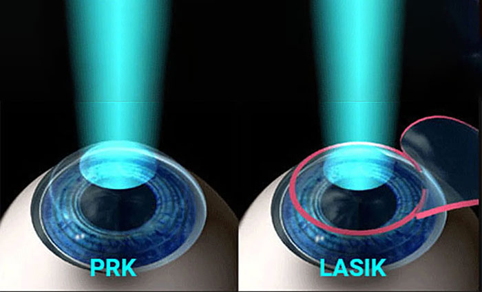 تفاوت عمل پی ار کی و عمل لازک