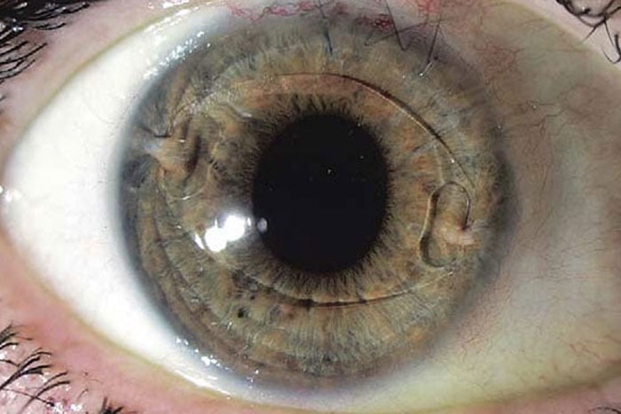 شرایط بیمار بعد از عمل کاشت لنز