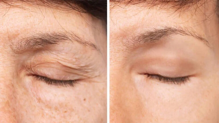 بلفاروپلاستی با لیزر بهتره یا جراحی؟ مقایسه دقیق و جامع