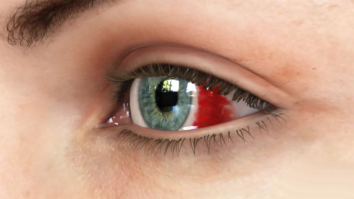 عارضه هايفما Hyphema چشم چیست؟