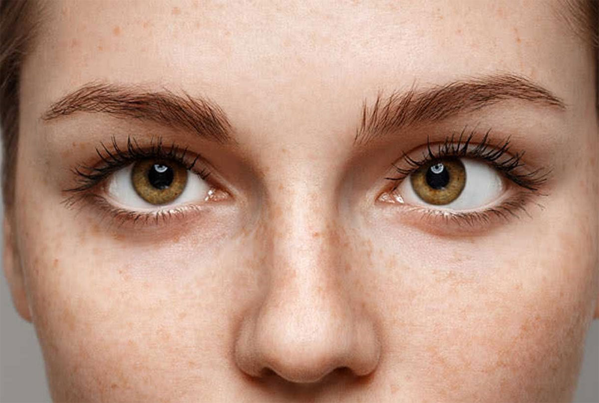 انحراف چشم (استرابیسم) چیست؟