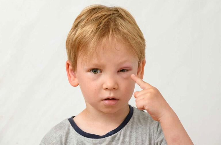 ورم چشم چیست و چرا ایجاد می‌شود؟